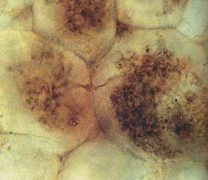 Pilzgeflecht als dunkle Füllung in Pflanzenzellen, nach H. Kerp