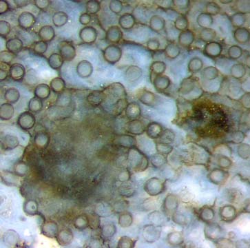 nematophyte with clot